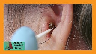 Chunky Earwax Removal  Auburn Medical Group [upl. by Timoteo905]