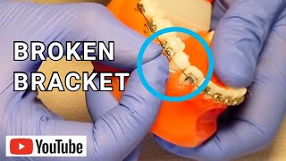 Broken Braces Broken Loose or Sliding Bracket What To Do [upl. by Son362]