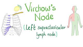 Virchows Node Left Supraclavicular Lymph Node  Cancer  Oncology [upl. by Ayaladnot]