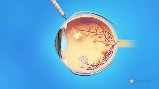 Eye Injections for Central Retinal Vein Occlusion CRVO [upl. by Neelsaj]