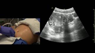 Transabdominal Pelvis Ultrasound Scanning Techniques [upl. by Adym67]