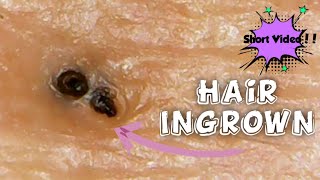 Hair Ingrown Removalshort video [upl. by Reema]