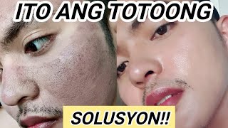 TOTOONG SOLUSYON SA PEKAS SA MUKHA Dark Spots Melasma etc [upl. by Aryc147]