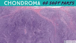 Chondrosarcoma vs Enchondroma Bone Pathology with Dr Andrew Rosenberg [upl. by Elad]