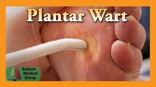 Plantar Wart Treatment  Auburn Medical Group [upl. by Sicnarf]