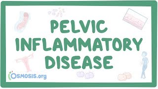 Pelvic inflammatory disease  causes symptoms diagnosis treatment pathology [upl. by Ki]