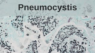 Pneumocystis Pneumonia  Pathology mini tutorial [upl. by Castillo124]