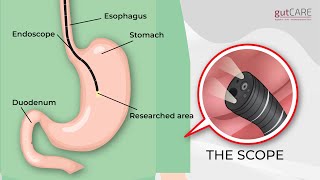 Preparing For Your Gastroscopy OGD  GUTCARE [upl. by Alake]