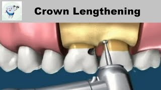 Crown Lengthening Procedure Animation [upl. by Renner]