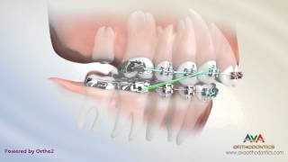 Orthodontic Treatment for Overbite Overjet  Removing Second Molar [upl. by Animehliw]