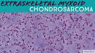 Myxofibrosarcoma 101Explained by a Sarcoma Pathologist [upl. by Warms16]