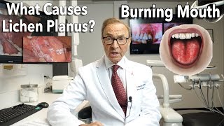 Lichen Planus  Burning Mouth Symptoms  Causes  Treatment [upl. by Ashford]