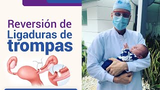 Reversión de la ligadura de trompas l Dr Juan Luis Giraldo [upl. by Farrel12]