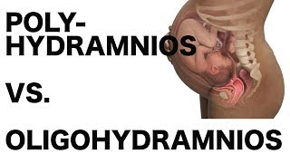 Polyhydramnios vs Oligohydramnios [upl. by Trebloc756]