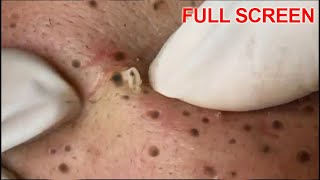 Blackheads Removal  Best Pimple Popping Videos [upl. by Teage495]