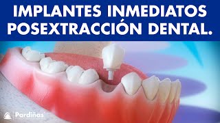 Implantes dentales inmediatos posextracción dental © [upl. by Ecinuahs]