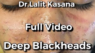 Deep Blackhead Removal FULL VIDEO by DrLalit Kasana [upl. by Uokes]