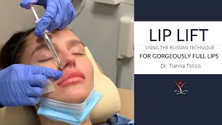 Lip Filler Lip Lift with the Russian Technique [upl. by Frey]