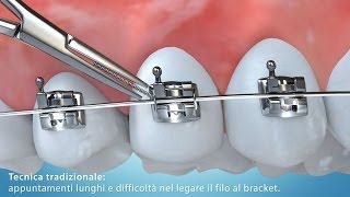 Video Animazione 3D tecnica di allineamento dentale con bracket [upl. by Nilyac]