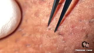 Ingrown Hair Removal ep25 [upl. by Formica]