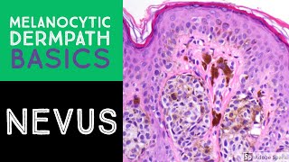 What is Neurofibromatosis Type 1 NF1 [upl. by Droffig304]