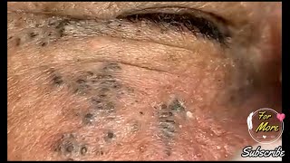 Dr Pop  Deep Blackheads in old Skin removing amp treatment 2020 Part 5 [upl. by Bourne480]