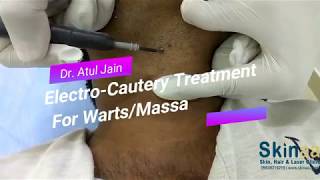 WartsMole Removal Treatment with Electrocautery in Jaipur India – Dr Atul Jain [upl. by Reel432]