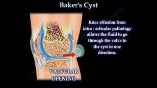 Bakers Cyst  Everything You Need To Know  Dr Nabil Ebraheim [upl. by Alvina53]