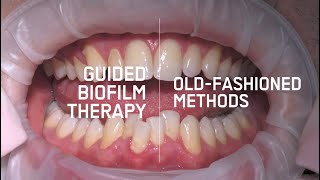 Guided Biofilm Therapy VS Old Hygiene Treatment [upl. by Modeerf]