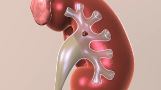 Urology Bladder stones [upl. by Neit]