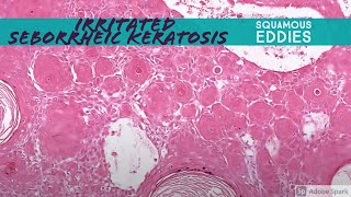 Irritated Seborrheic Keratosis squamous eddies 5Minute Pathology Pearls [upl. by Forrer]