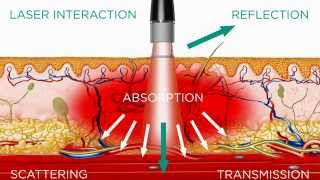 High Intensity Laser  Medical Effects [upl. by Shepard113]