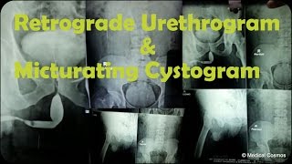 RGU MCU Retrograde Urethrogram and Micturating Cystogram Case Interpretation [upl. by Yelrahs]