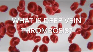 Isolated Calf Vein Thrombosis DVT Below the Knee [upl. by Intruok]