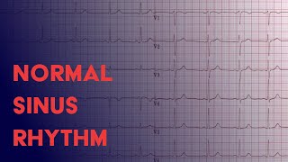 Normal Sinus Rhythm  EKG ECG Interpretation [upl. by Saihtam]