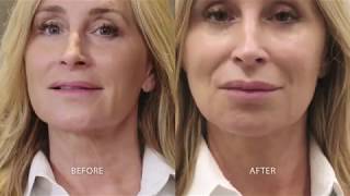 TempSure 20 Minute NonSurgical Face Lift [upl. by Broucek]