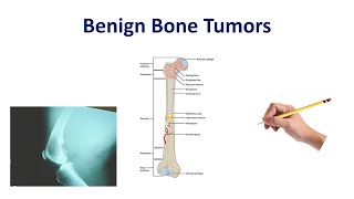 Chondroma Chondrosarcoma And Osteochondroma  Pathology [upl. by Kirtley]