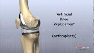 Artificial Knee Replacement [upl. by Sacks807]