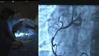 Cardiac Catheterization for Angioplasty [upl. by Leakcim358]