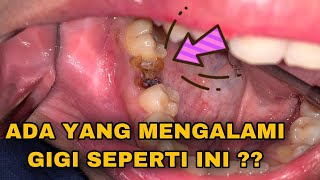 SISA AKAR GIGI  Dokter Gigi Tri Putra [upl. by Gaspar]