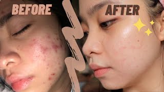 The best ANTI ACNE CREAM ✨  my holy grail  TRETINOIN [upl. by Cathlene]