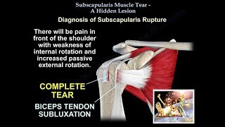 Subscapularis Muscle Tear A Hidden Lesion  Everything You Need To Know  Dr Nabil Ebraheim [upl. by Fawnia871]