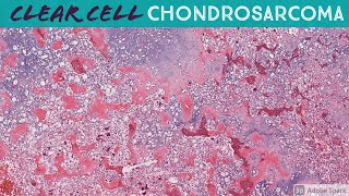 Clear Cell Chondrosarcoma [upl. by Roel983]