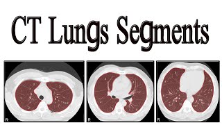 CT lungs segments [upl. by Nohsar]