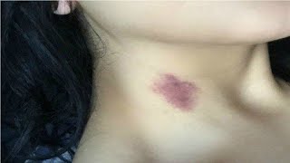 how to get a fake hickey with a bottle [upl. by Malonis]