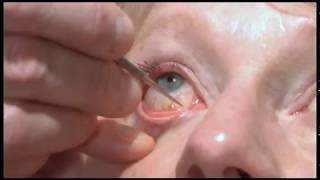 Oculoplastics basic exam Lacrimal system examination [upl. by Sholom]