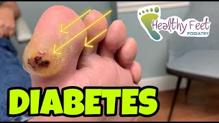 Diabetic Blister How to Treat Diabetic Ulcers [upl. by Houser]