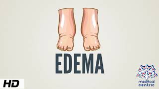 Edema Causes Signs and Symptoms Diagnosis and Treatment [upl. by Star]