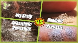 Dry Scalp vs Dandruff vs Seborrheic Dermatitis vs Psoriasis [upl. by Annaek420]