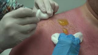 Popping Big Sun Burn Blisters with Dr G [upl. by Stevy878]